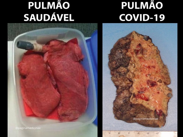 Pulmão do corona assusta médicos